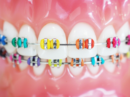 Frontal view of teeth and braces
