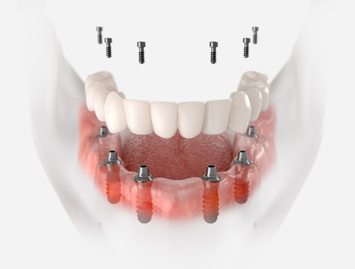 illustration of Implants