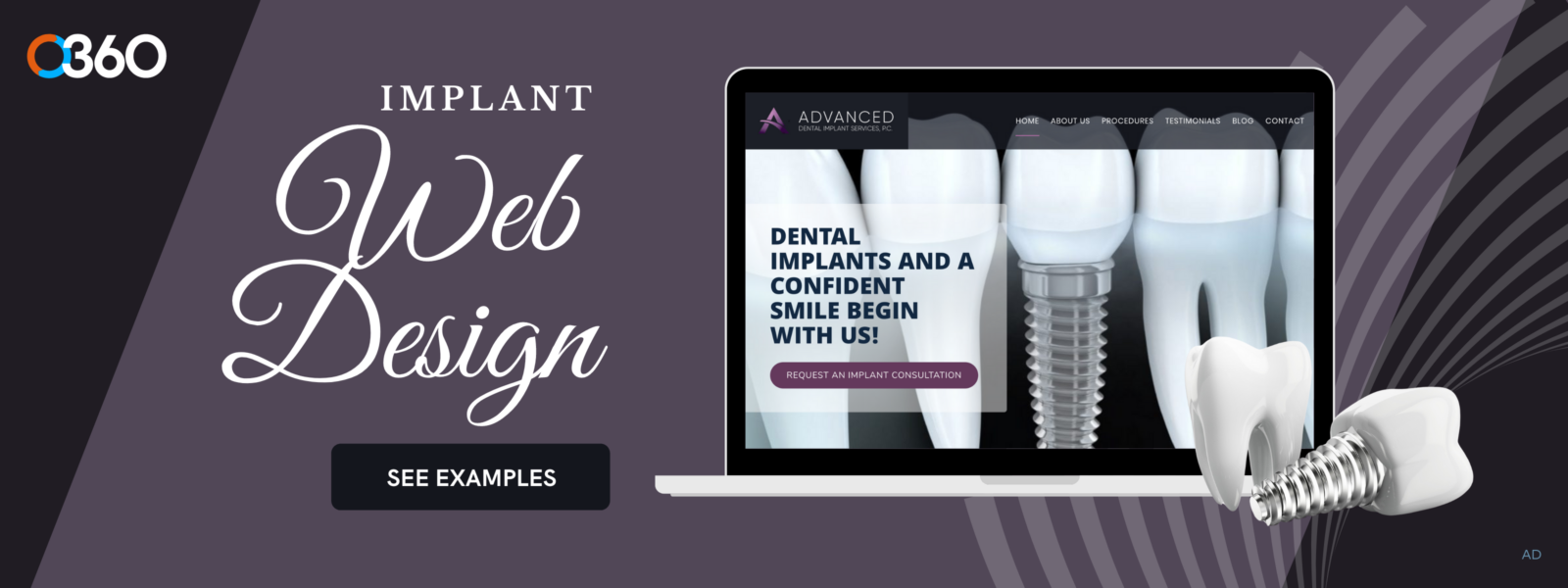 O360 ad – dental implant web design