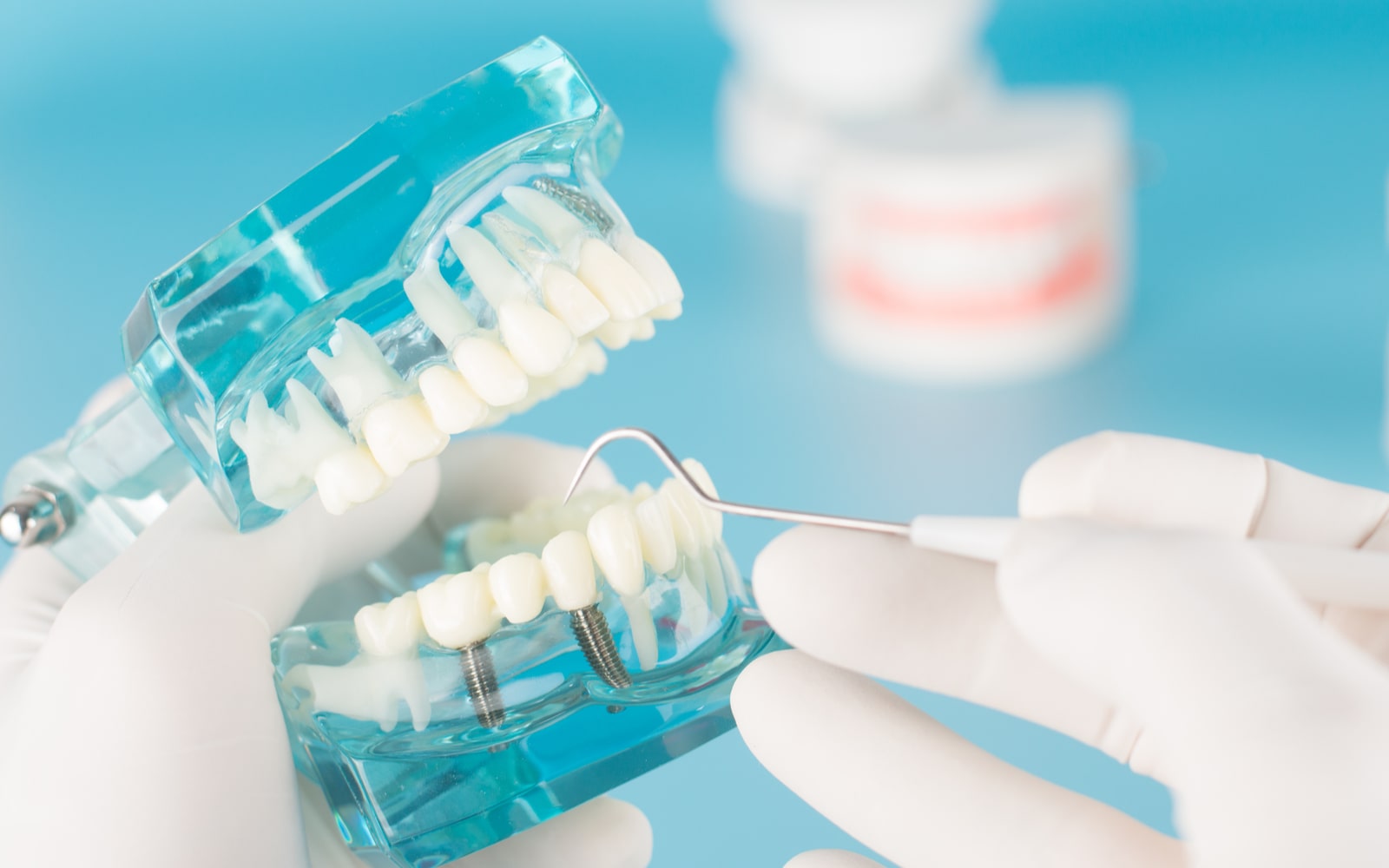 Best Dental Implant Brand